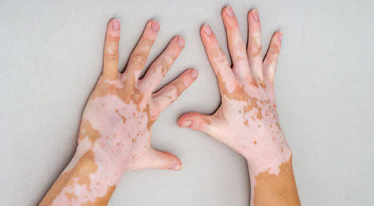 At-Home 308nm Laser: Clinical Protocols Made Easy