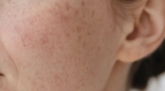 Understanding Dermatitis and Facial Hyperpigmentation: Mechanisms, Types, and Management