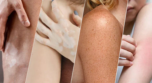 White Marks, Freckles, Patches on Skin: Causes, Diagnosis & Treatment