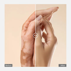 Portable 308nm Excimer UVB Light- Vitiligo/Psoriasis Light Therapy Device
