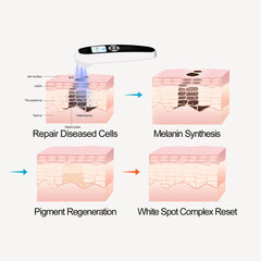Portable 308nm Excimer UVB Light- Vitiligo/Psoriasis Light Therapy Device