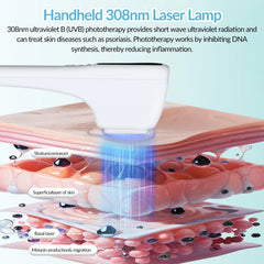 ZJZK 308 nm Excimer-Gerät – Effektive natürliche Lichttherapie für Psoriasis, Vitiligo und Ekzeme zu Hause