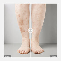 Portable 308nm Excimer UVB Light- Vitiligo/Psoriasis Light Therapy Device